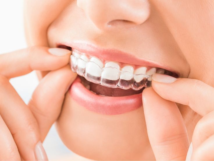 Invisalign Provider in Nizampet